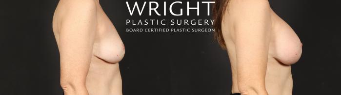 Before & After Breast Augmentation Case 681 Right Side View in Little Rock, Arkansas