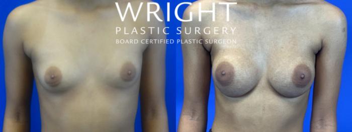 Before & After Breast Augmentation Case 69 Front View in Little Rock, Arkansas