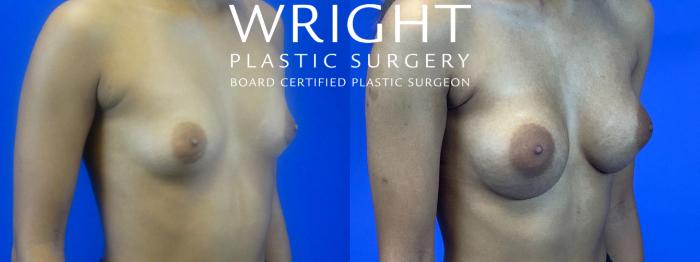 Before & After Breast Augmentation Case 69 Right Oblique View in Little Rock, Arkansas