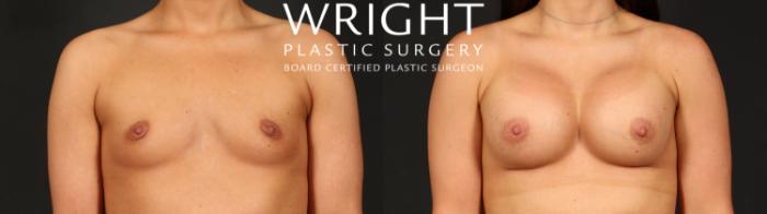 Before & After Breast Augmentation Case 690 Front View in Little Rock, Arkansas