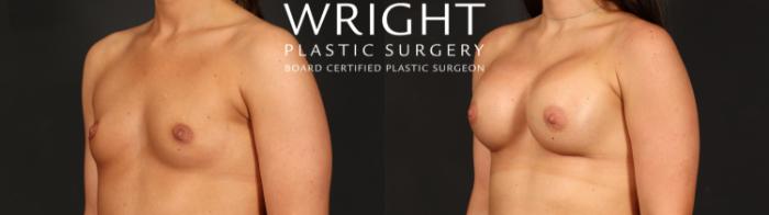 Before & After Breast Augmentation Case 690 Left Oblique View in Little Rock, Arkansas