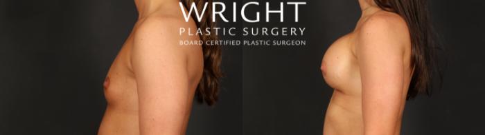 Before & After Breast Augmentation Case 690 Left Side View in Little Rock, Arkansas