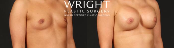 Before & After Breast Augmentation Case 690 Right Oblique View in Little Rock, Arkansas