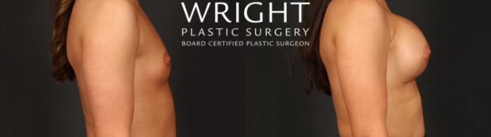 Before & After Breast Augmentation Case 690 Right Side View in Little Rock, Arkansas