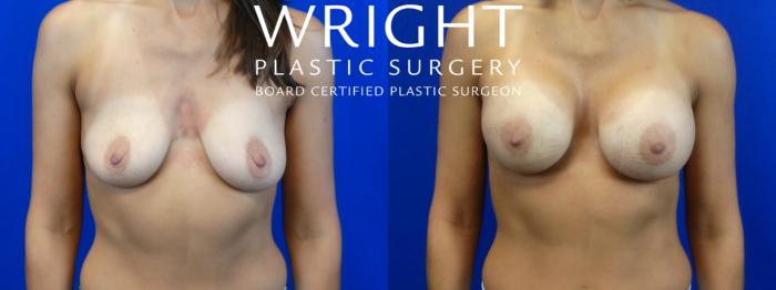 Before & After Breast Augmentation Case 8 Front View in Little Rock, Arkansas