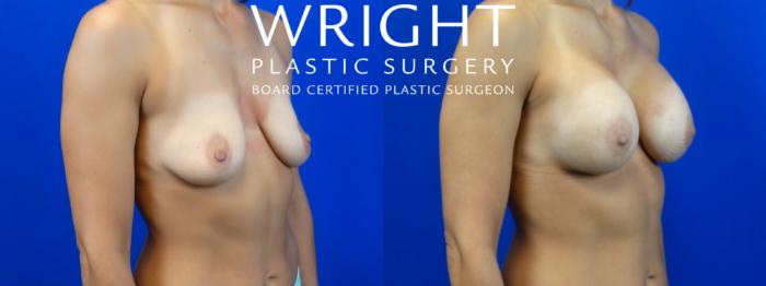 Before & After Breast Augmentation Case 8 Right Oblique View in Little Rock, Arkansas