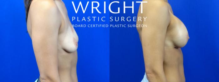 Before & After Breast Augmentation Case 8 Right Side View in Little Rock, Arkansas