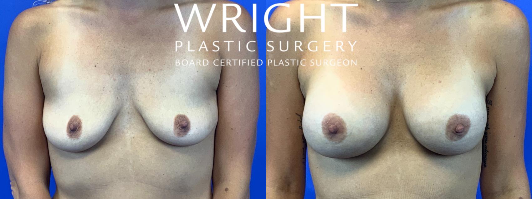 Before & After Breast Augmentation Case 88 Front View in Little Rock, Arkansas