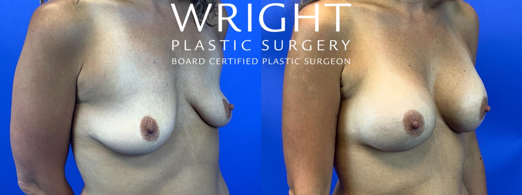 Before & After Breast Augmentation Case 88 Right Oblique View in Little Rock, Arkansas