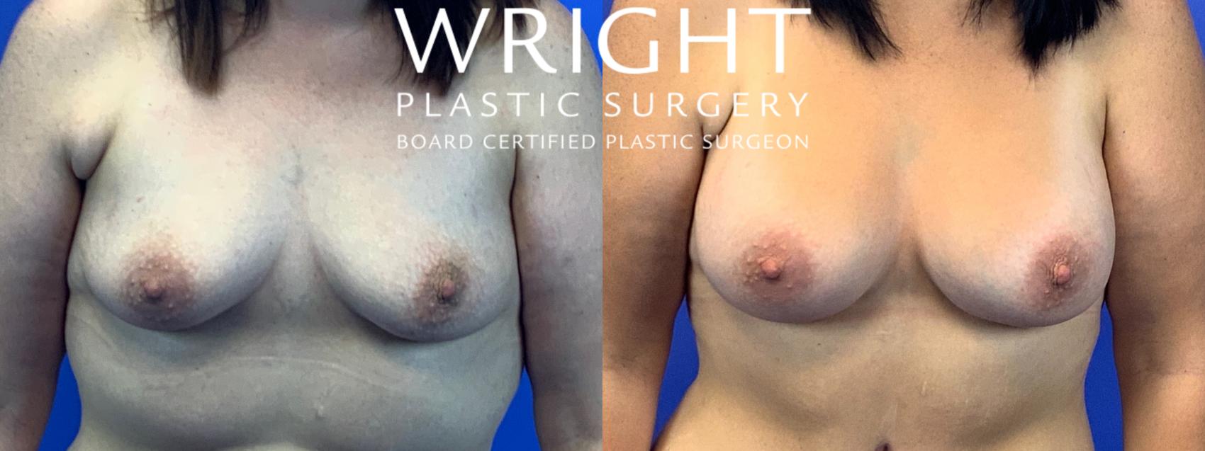 Before & After Breast Augmentation Case 90 Front View in Little Rock, Arkansas