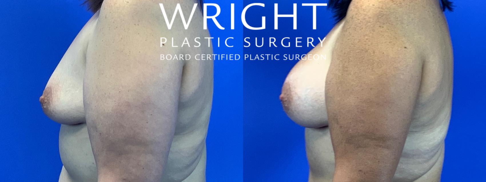 Before & After Breast Augmentation Case 90 Left Side View in Little Rock, Arkansas