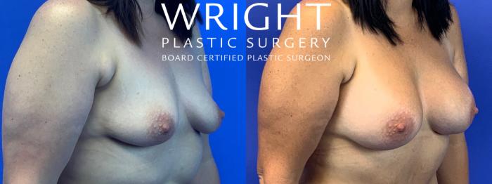 Before & After Breast Augmentation Case 90 Right Oblique View in Little Rock, Arkansas