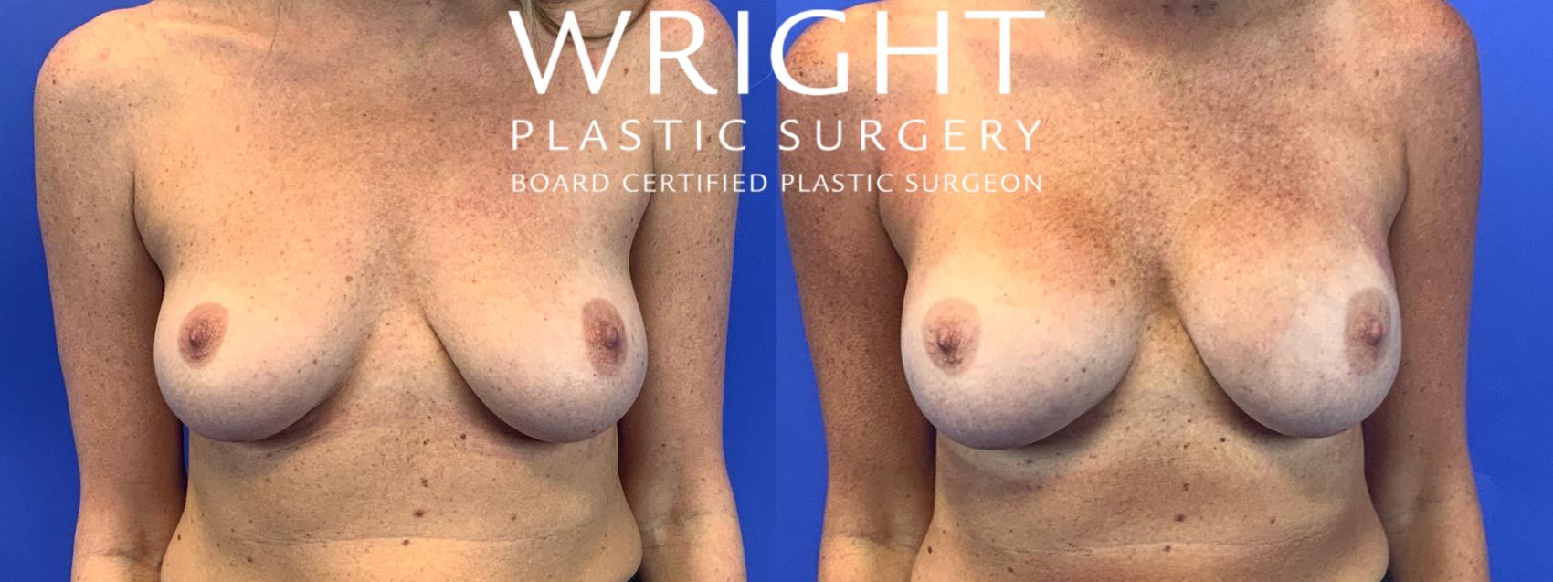 Before & After Breast Augmentation Case 91 Front View in Little Rock, Arkansas