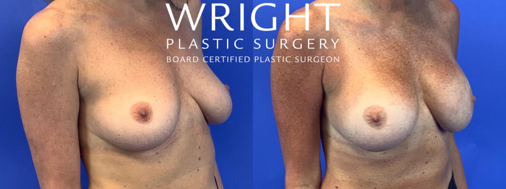 Before & After Breast Augmentation Case 91 Right Oblique View in Little Rock, Arkansas