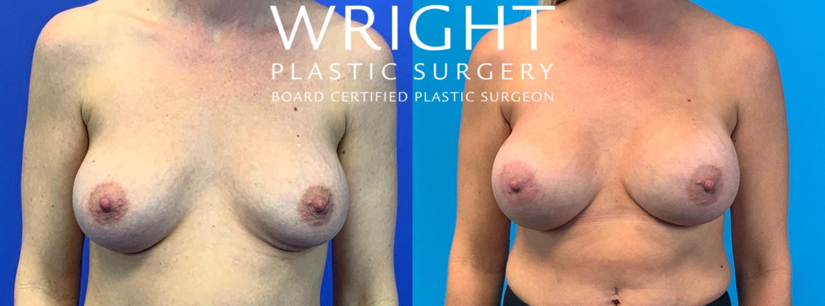 Before & After Breast Implant Exchange Case 147 Front View in Little Rock, Arkansas