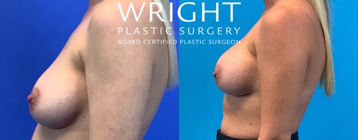 Before & After Breast Implant Exchange Case 147 Left Side View in Little Rock, Arkansas