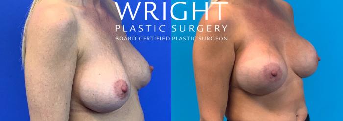 Before & After Breast Implant Exchange Case 147 Right Oblique View in Little Rock, Arkansas