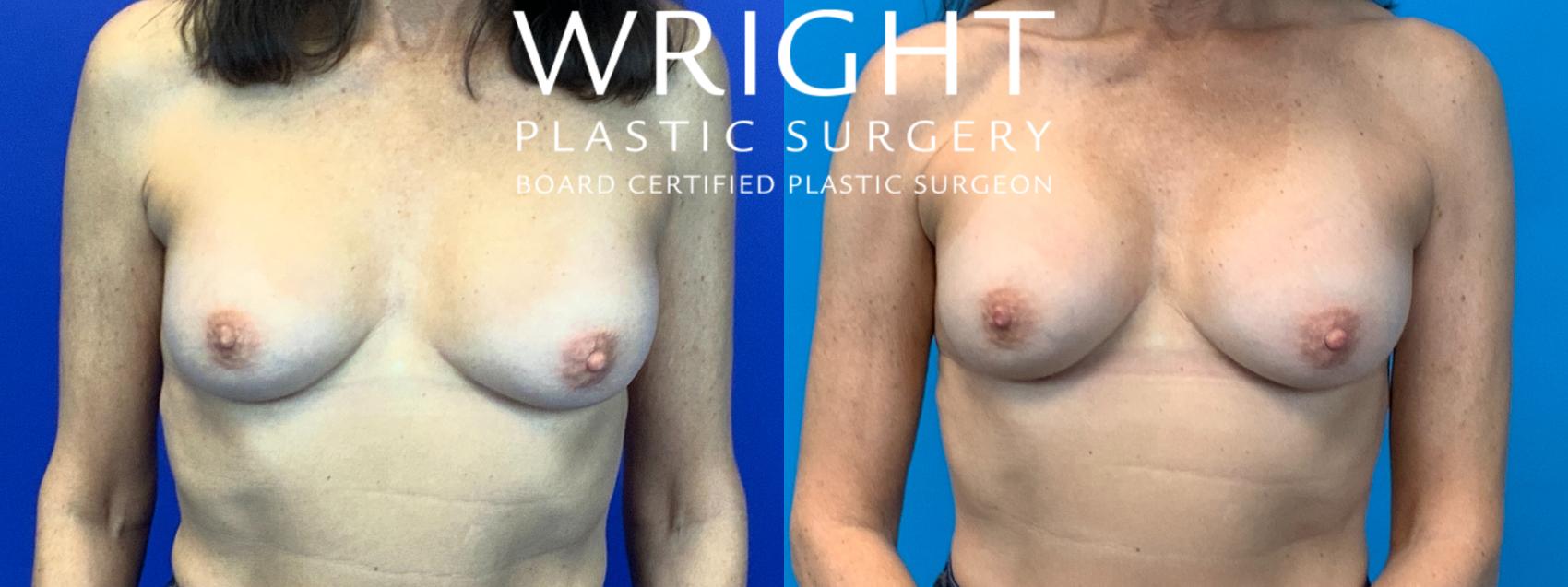 Before & After Breast Implant Exchange Case 148 Front View in Little Rock, Arkansas