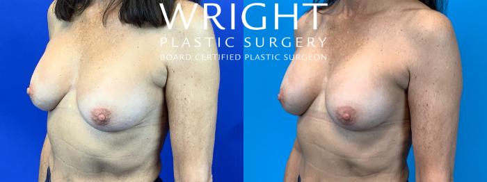 Before & After Breast Implant Exchange Case 148 Left Oblique View in Little Rock, Arkansas