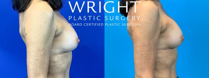 Before & After Breast Implant Exchange Case 148 Right Side View in Little Rock, Arkansas