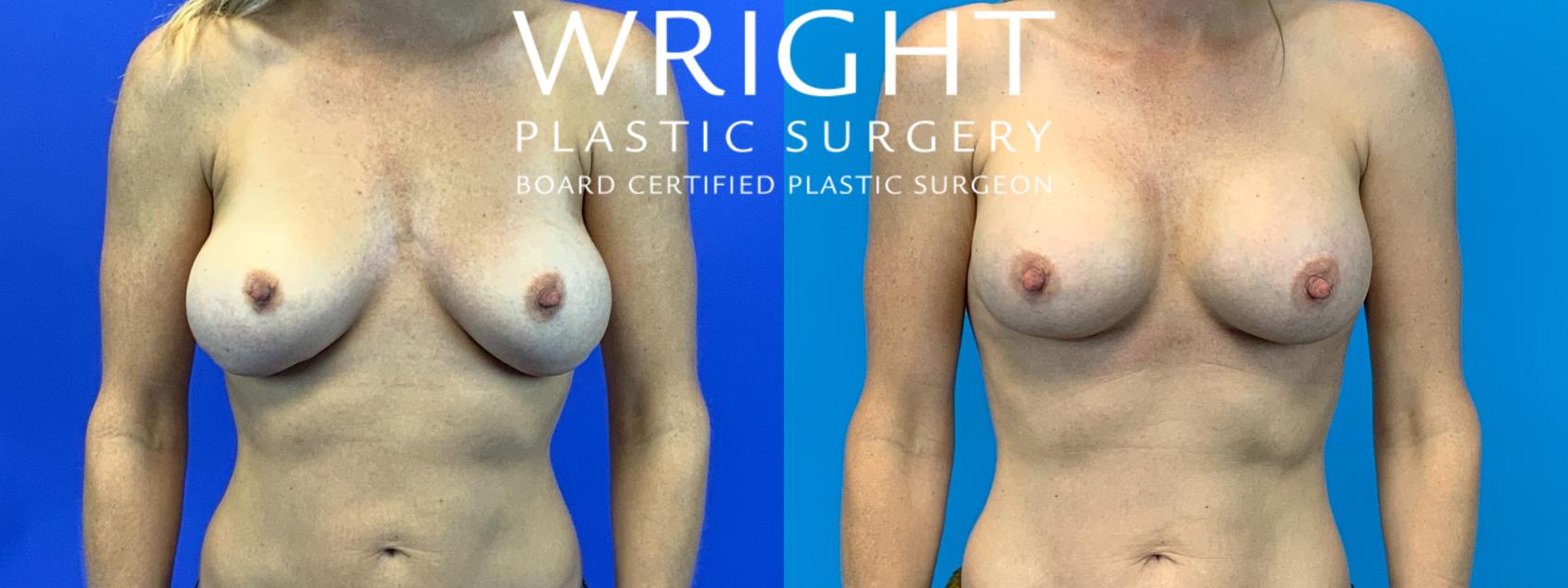Before & After Breast Implant Exchange Case 164 Front View in Little Rock, Arkansas