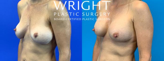 Before & After Breast Implant Exchange Case 164 Left Oblique View in Little Rock, Arkansas