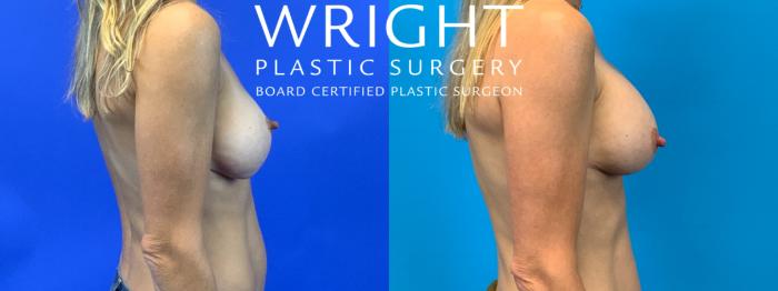 Before & After Breast Implant Exchange Case 164 Right Side View in Little Rock, Arkansas