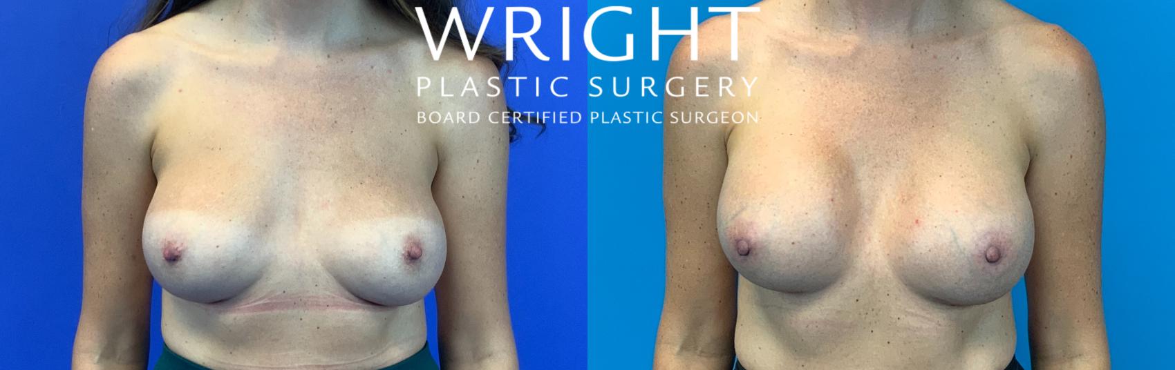 Before & After Breast Implant Exchange Case 178 Front View in Little Rock, Arkansas
