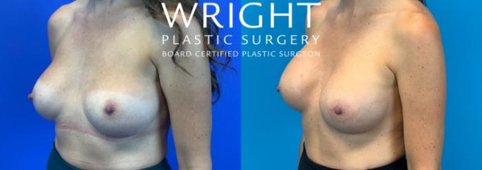 Before & After Breast Implant Exchange Case 178 Left Oblique View in Little Rock, Arkansas