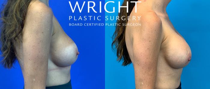 Before & After Breast Implant Exchange Case 178 Right Side View in Little Rock, Arkansas