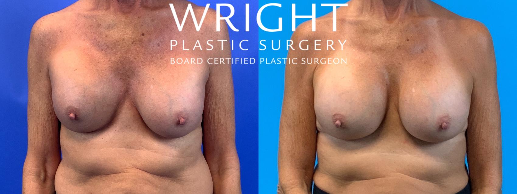 Before & After Breast Implant Exchange Case 220 Front View in Little Rock, Arkansas