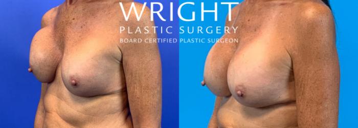 Before & After Breast Implant Exchange Case 220 Left Oblique View in Little Rock, Arkansas
