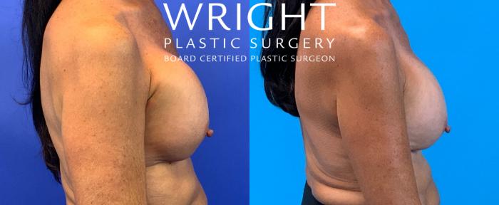 Before & After Breast Implant Exchange Case 220 Right Side View in Little Rock, Arkansas