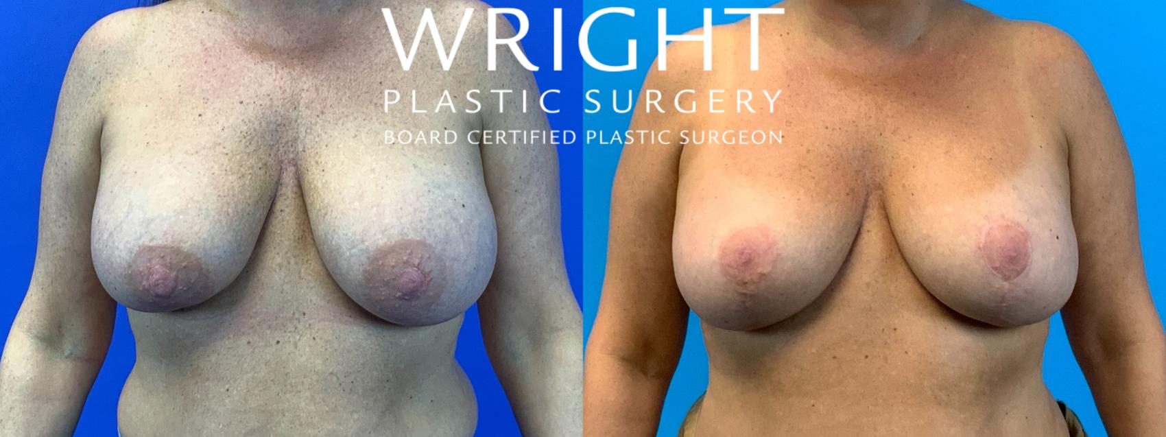 Before & After Breast Lift Case 222 Front View in Little Rock, Arkansas