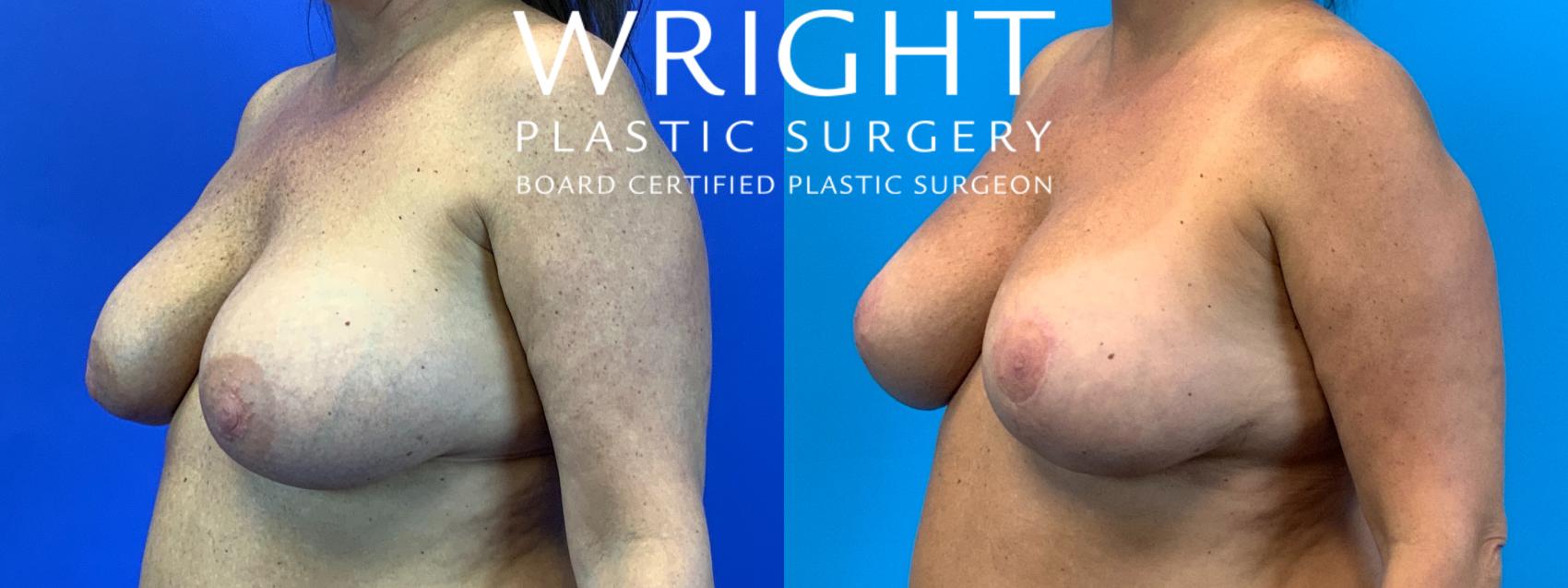 Before & After Breast Implant Exchange Case 222 Left Oblique View in Little Rock, Arkansas