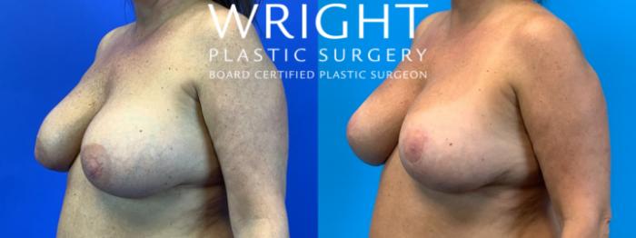 Before & After Breast Implant Exchange Case 222 Left Oblique View in Little Rock, Arkansas