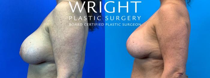 Before & After Breast Implant Exchange Case 222 Left Side View in Little Rock, Arkansas