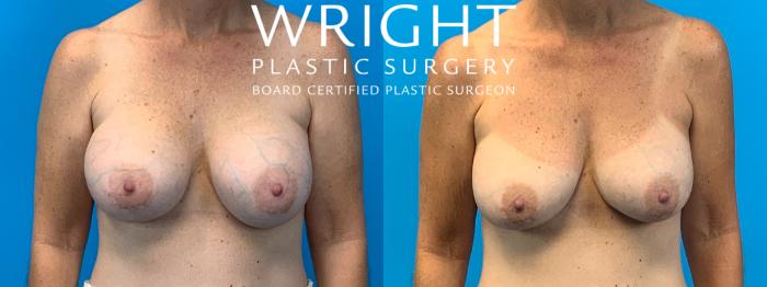 Before & After Breast Implant Exchange Case 226 Front View in Little Rock, Arkansas