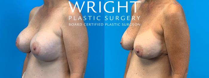 Before & After Breast Implant Exchange Case 226 Left Oblique View in Little Rock, Arkansas
