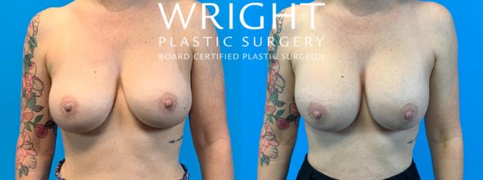 Before & After Breast Implant Exchange Case 238 Front View in Little Rock, Arkansas