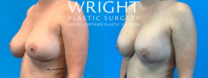 Before & After Breast Implant Exchange Case 238 Left Oblique View in Little Rock, Arkansas