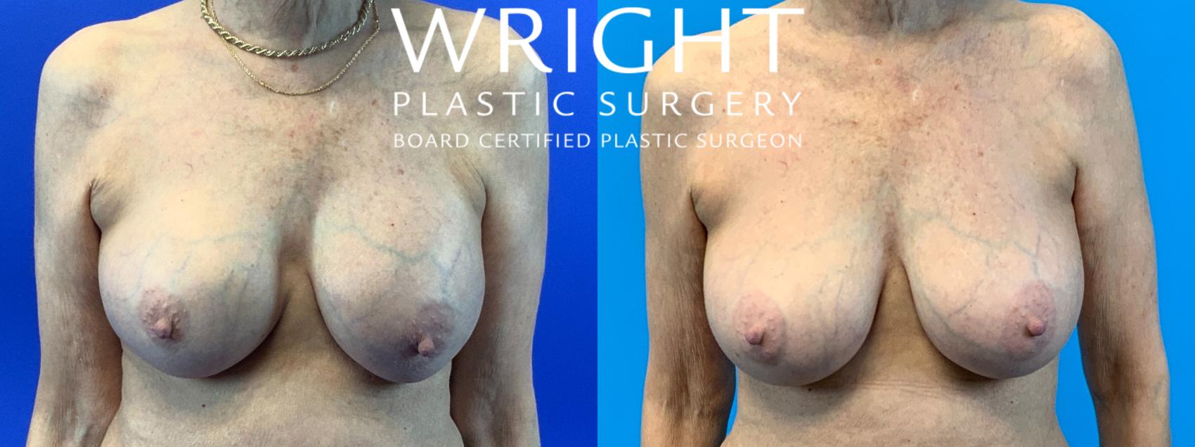 Before & After Breast Implant Exchange Case 250 Front View in Little Rock, Arkansas