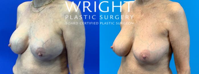 Before & After Breast Implant Exchange Case 250 Left Oblique View in Little Rock, Arkansas