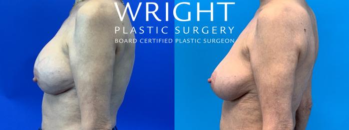 Before & After Breast Implant Exchange Case 250 Left Side View in Little Rock, Arkansas