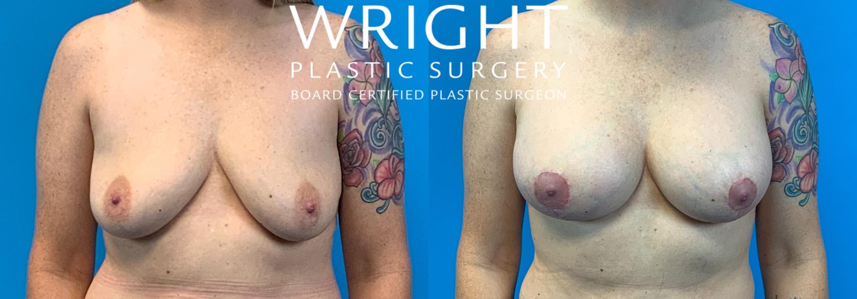 Before & After Breast Lift Case 263 Front View in Little Rock, Arkansas