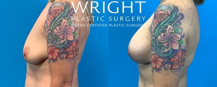 Before & After Breast Implant Exchange Case 263 Left Side View in Little Rock, Arkansas