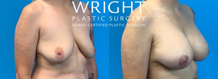 Before & After Breast Lift Case 263 Right Oblique View in Little Rock, Arkansas