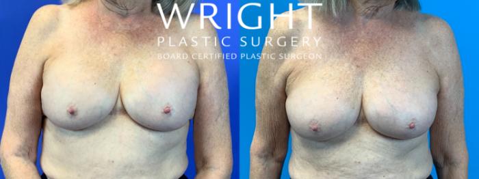 Before & After Breast Implant Exchange Case 265 Front View in Little Rock, Arkansas