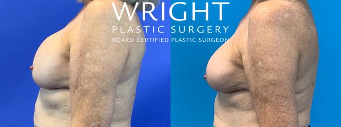 Before & After Breast Implant Exchange Case 265 Left Side View in Little Rock, Arkansas