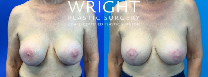 Before & After Breast Implant Exchange Case 271 Front View in Little Rock, Arkansas